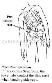 Anatomy between hip lower ribcage in back : Prolotherapy For Iliocostalis Syndrome Caring Medical Florida