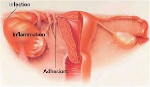 Differential Diagnoses Endometriosis