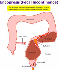 Image result for Fecal Incontinence
