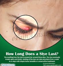 How Long Does A Stye Last Eye Stye Remedies Skin Care Pimples Stye Remedy
