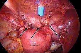 This is pelvic anatomy laparoscopic hysterectomy by irocket on vimeo, the home for high quality videos and the people who love them. Findings Of Pelvic Endometriosis At Transvaginal Us Mr Imaging And Laparoscopy Radiographics