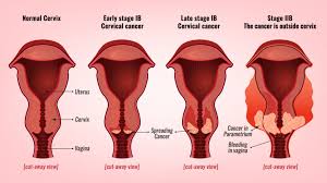 Also, bleeding or spotting that occurs after a woman has gone through menopause is a reason to get evaluated. Cervical Cancer Stages Prof Andreas Obermair Professor Andreas Obermair