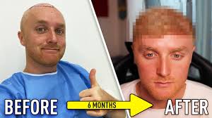 Should ksi get a hairline lowering procedure or a beard transplant? 19 02 Mb My 6 Month Hair Transplant Results Before After Download Lagu Mp3 Gratis Mp3 Dragon