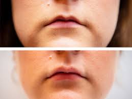 Check spelling or type a new query. My First Time What It S Really Like To Get Lip Fillers Marie Claire