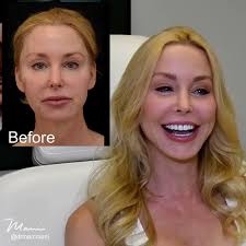 Darnell's TCF Lift by Dr. Marc Mani