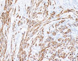 Benign mesothelioma is a tumor that isn't cancerous and doesn't spread to other parts of the body. Pathology Outlines Diffuse Malignant Mesothelioma