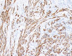 Cells (where there is often associated acute inflammation) uniform thickness of the process. Pathology Outlines Diffuse Malignant Mesothelioma