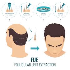 Fue Hair Transplant Hair Restoration Surgery Hair Clinic Hair Transplant In India