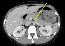 Nutcracker Syndrome A Rare Cause Of Left Flank Pain That Can Also Manifest As Unexplained Pelvic Pain Sciencedirect