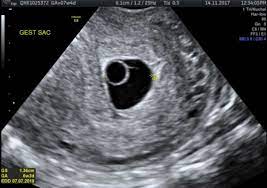 A blighted ovum causes about one out of two miscarriages in the first trimester of pregnancy. Has Anyone Ever Been Misdiagnosed With A Blighted Ovum June 2018 Page 2 Babycenter Australia