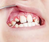 Meaning, pronunciation, synonyms, antonyms, origin, difficulty here you'll get most accurate definitions, close synonyms and antonyms, related words, phrases and. What Is Gingivitis Gingivitis Meaning Definition