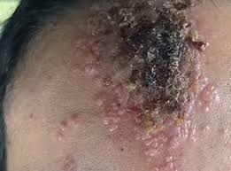 I got herpes on my face at a concert — and ended up in a hospital