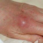 Image result for phlegmon of hand)
