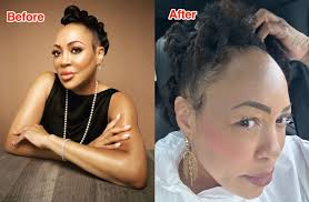 Why Some Black Women Are Using Botox to Achieve Smoothed Edges