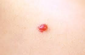 Angiomas are benign tumors that result from an overgrowth. Cherry Angiomas Laser Treatments Dermatologist Dr Gergana Gallacher Dermatology And Laser Centre