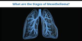 Check spelling or type a new query. The 4 Mesothelioma Stages Explained