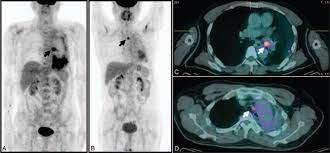 Pet Ct Scans Showed The Mass With Increased 18 Fdg Uptake In Left Main Download Scientific Diagram