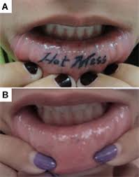 While they're harmless, amalgam tattoos are sometimes mistaken for melanomas, which require. Laser Removal Of Decorative Tattoos Inside The Mouth