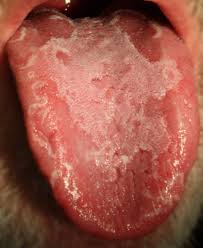 Image result for Fissured tongue
