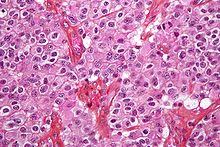 Brain tumors are abnormal growths of cells in the brain. Brain Tumor Wikipedia