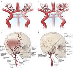Frontiers | Physiological and pathophysiological mechanisms of the  molecular and cellular biology of angiogenesis and inflammation in moyamoya  angiopathy and related vascular diseases