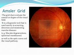 Amsler Grid