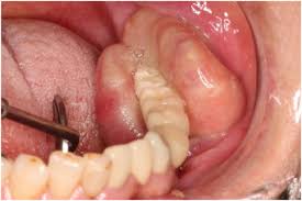Image result for granuloma gum disease
