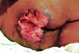 Evolution may be rapid exposing additional layers of tissue even with treatment. Patient Develops Severe Pressure Ulcers Nursing Homes And Hospital Settle