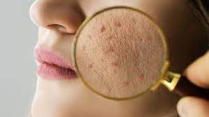 Acne Specialist in Atlanta, Georgia - Acworth Dermatology