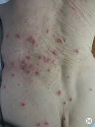 Image result for scabies human bites