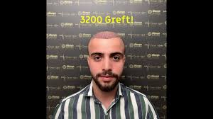 Batman Dunya Hastanesi Sac Ekimi Randevu Hatti 0533 458 28 98 Youtube