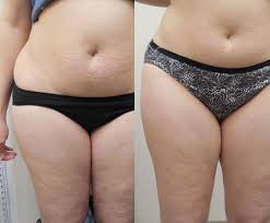 Body Contouring Treatments Spring Tx Velashape Family Weight Wellness Clinic And Medi Spa