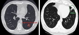 This is the most common type of lung cancer in both smokers and those who have never smoked. Google S Lung Cancer Detection Ai Outperforms 6 Human Radiologists Venturebeat