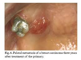 Using a small camera to inspect your throat. Oral Non Squamous Malignant Tumors Diagnosis And Treatment