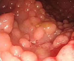 Skin cancer is the most common cancer and will affect one in five americans during their lifetime. Cancer Syndrome Wikipedia