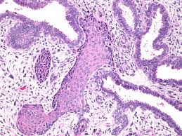 What is a borderline or malignant phyllodes tumour? Webpathology Com A Collection Of Surgical Pathology Images