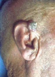 Image result for cornu cutaneum)