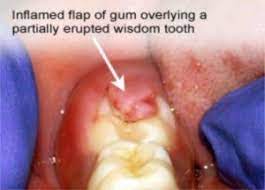 He told me that the impacted wisdom tooth will form a gap between itself and the 2nd molar which allows food and bacteria to grow and become infected it depends on the person, there is no hard and fast rule. When Should Wisdom Teeth Be Removed Plaza Dental