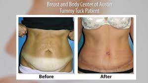 Recovery after an abdominoplasty (tummy tuck) full recovery from an abdominoplasty is usually experienced after a time of roughly six months and in some cases, it may take longer. Patients Are Digging The Drainless Tummy Tuck