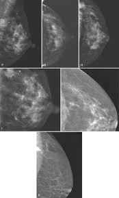Image result for Mammogram Interpretation