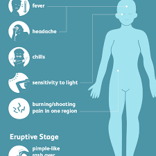 When it was kiara's turn, her papa huke told the girls to put her on bottom left, meaning degenerate and dumb. Shingles Signs Symptoms And Complications