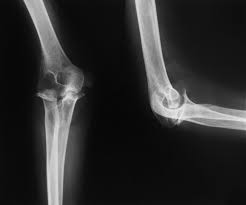 Image result for XRay Changes in Rheumatic Conditions