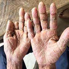 Quali sono le malattie autoimmuni? Sclerodermia Disturbi Cause E Cura Issalute