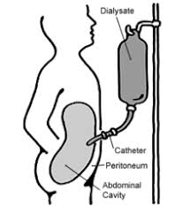 Dialysis Wikipedia