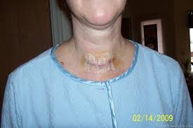 Thyroid Surgery Recovery Photos Progress Reports What To Expect After Thyroid Surgery Thyroid Surgery Thyroid Surgery Recovery Surgery Recovery