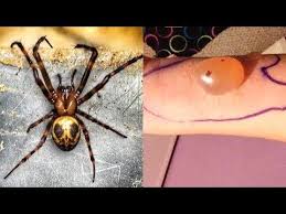 Most Venomous Spiders On Earth Youtube Spider Bites Spider Venom Brown Recluse Spider