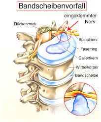 Bandscheibenvorfall Neurochirurg Dr Med Ralf Laege Und Henning Cordes