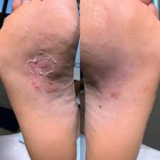 Image result for Tinnea vesiculosa