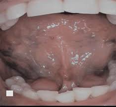 Image result for black tongue symptoms