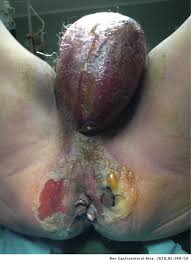Most cases are sparked by a combination of aerobic (requiring air) and anaerobic (living without oxygen) bacteria. Fournier S Gangrene Caused By Streptococcus Anginosus A Rare Etiologic Agent Revista De Gastroenterologia De Mexico